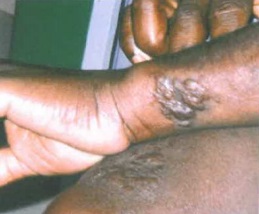 La lèpre, une maladie de la peau peut avoir de lourdes conséquences (Crédit photo : ARS)